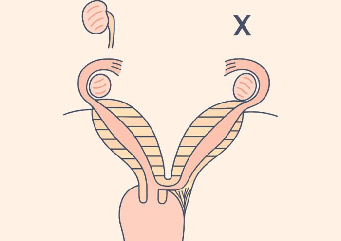 Malformación uterina, que asocia agenesia renal y atresia cérvico-vaginal,