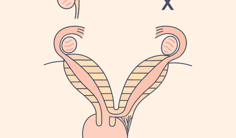 Malformación uterina, que asocia agenesia renal y atresia cérvico-vaginal,