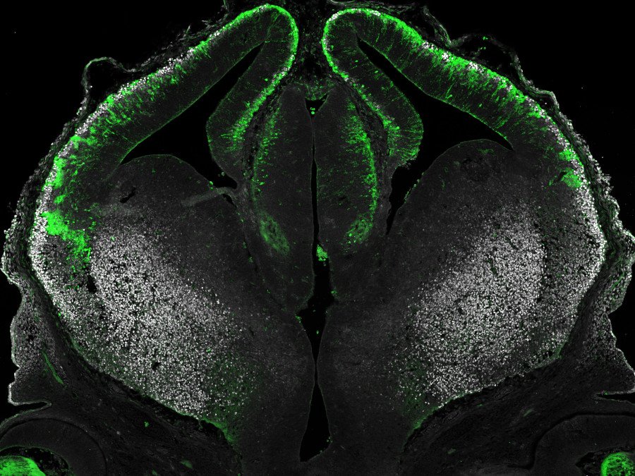 Imagen confocal de un embrión de ratón E13.5 transfectado con un vector para la expresión ectópica del factor de transcripción Dbx1, lo que conduce a la formación de agregados celulares debido al aumento de la adhesión mediada por Pcdh8. La interacción entre Dbx1 y Pcdh8, tal como se describe en Cwetsch et al., regula el desarrollo de la corteza cerebral. Crédito de la imagen: Andrzej W. Cwetsch.
