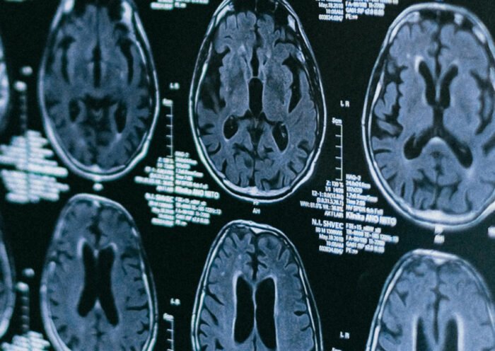 cerebro