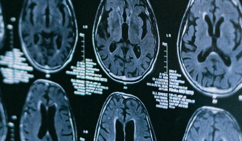 cerebro