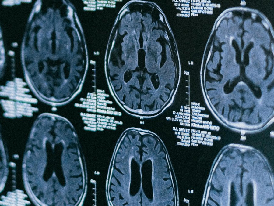 cerebro