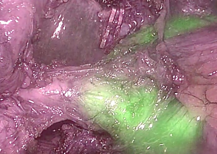 Cirujía asistida con fluorescencia. Créditos: F.X.Molina