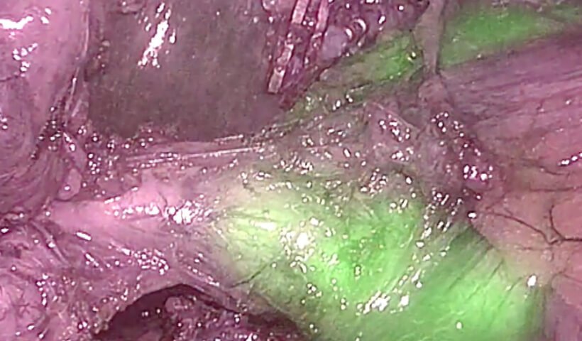 Cirujía asistida con fluorescencia. Créditos: F.X.Molina