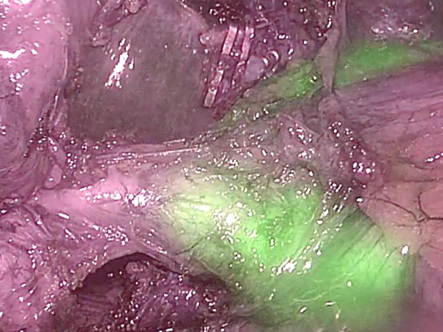 Cirujía asistida con fluorescencia. Créditos: F.X.Molina